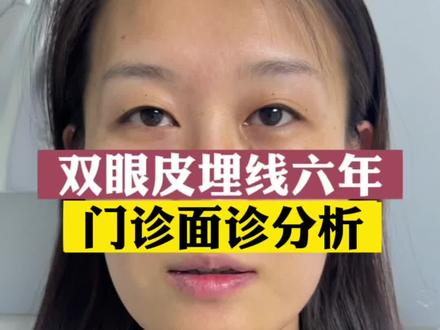 埋线双眼皮六年#双眼皮蜕变记 #双眼皮 #西安双眼皮陈杰