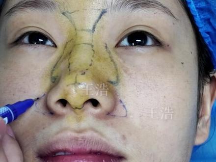 最后再捏捏我的原生鼻! #变美 #鼻整形 #鼻修复 #郑州王浩 #妈生鼻