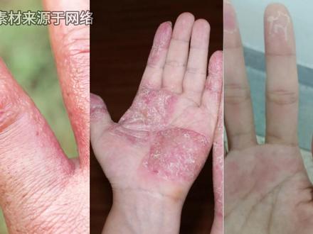 手指总裂口子,可能是这3种病 #手部湿疹 #手癣 #剥脱性角质松解症