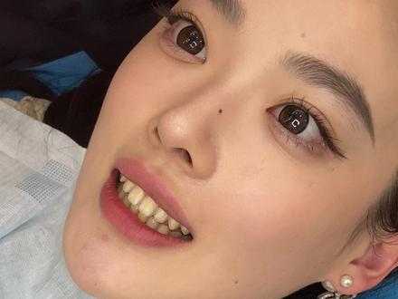 苹果原相机牙贴面原声版来了!!
本身我的牙齿是挺齐的但是因为我每天都要喝很多咖啡和点蚊香的原因,导致牙齿特别黄,在纠结半年后终于做了#美白牙齿 #牙齿健康 #牙齿美白 #牙齿