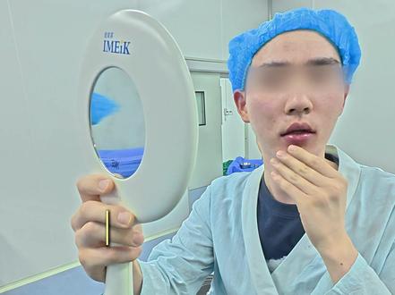 第一视角体验peek下巴填充全过程~ #余学元 #余学元peek #第一视角 #下巴后缩 #沉浸式
