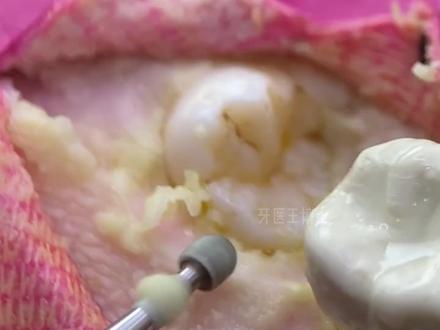 没有完全长出的智齿怎么拔除呢?第一步就是翻瓣啦,让足够的牙体暴露出来#智齿 #阻生智齿 #智齿拔除 #口腔科普
