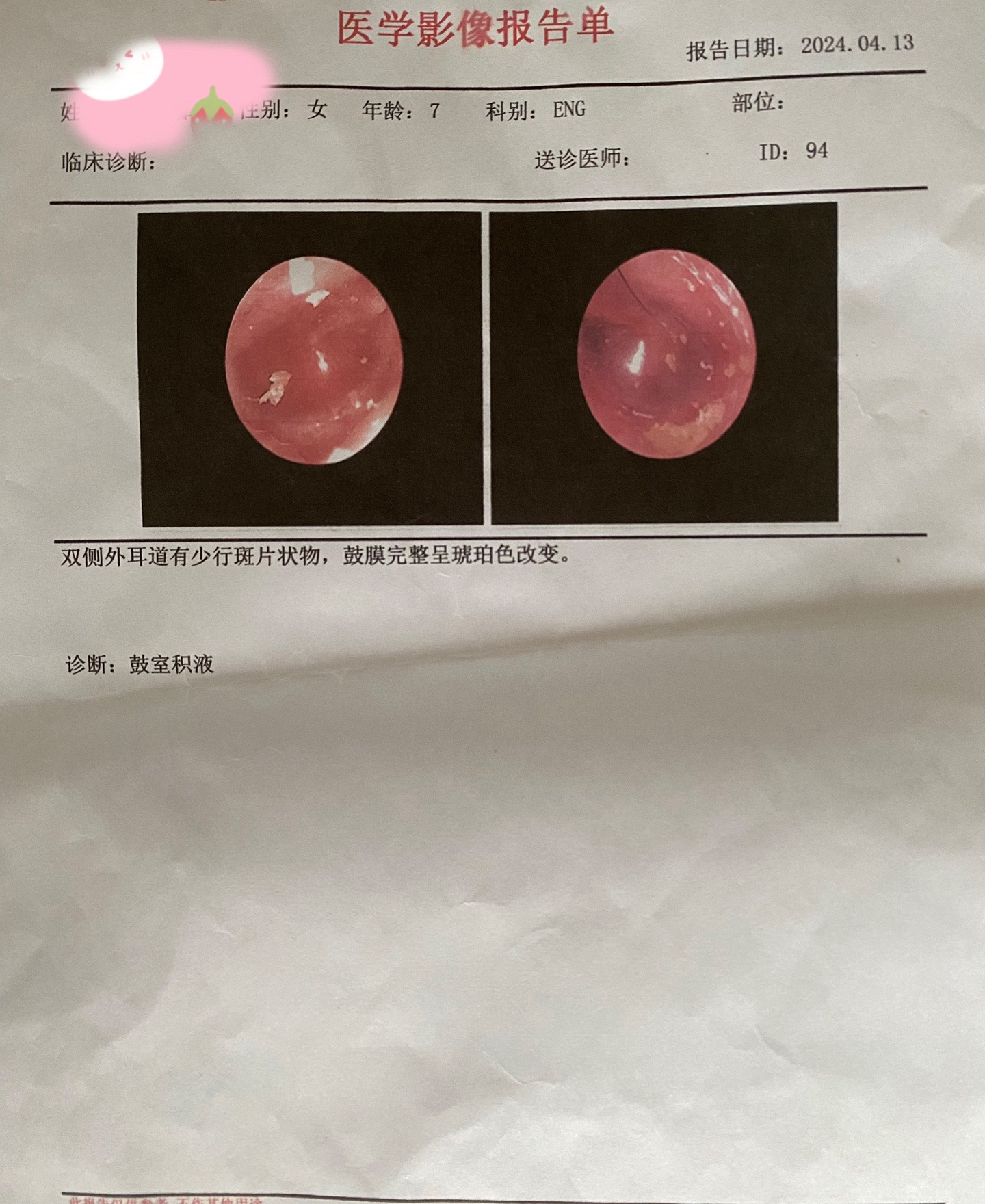 孩子3月份反映耳朵里有异响,4学3日检查右耳鼓室积液,分泌性中耳炎