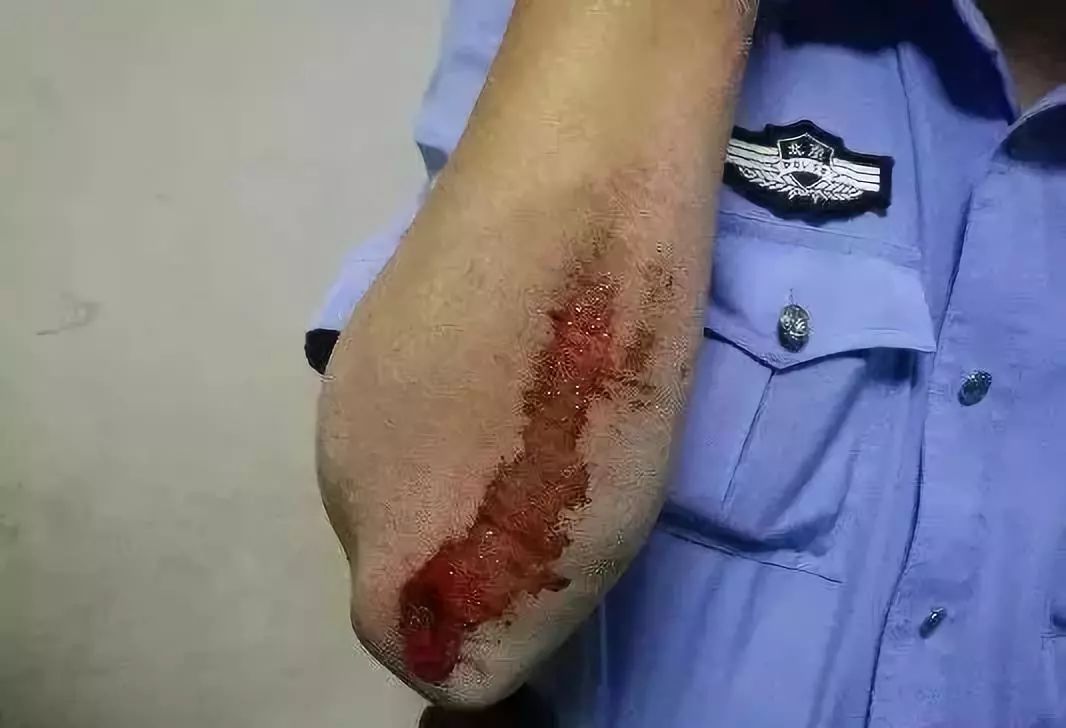 是刻进血肉里的"荣耀勋章"命悬一线,也不后悔成为这个家庭的一份子.