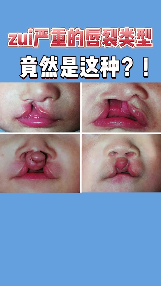 兔唇音是什么