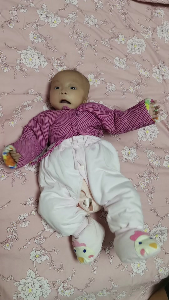 歌舞伎综合症小女孩妍妍_歌舞伎面综合症小女孩_歌舞伎综合症 宝宝