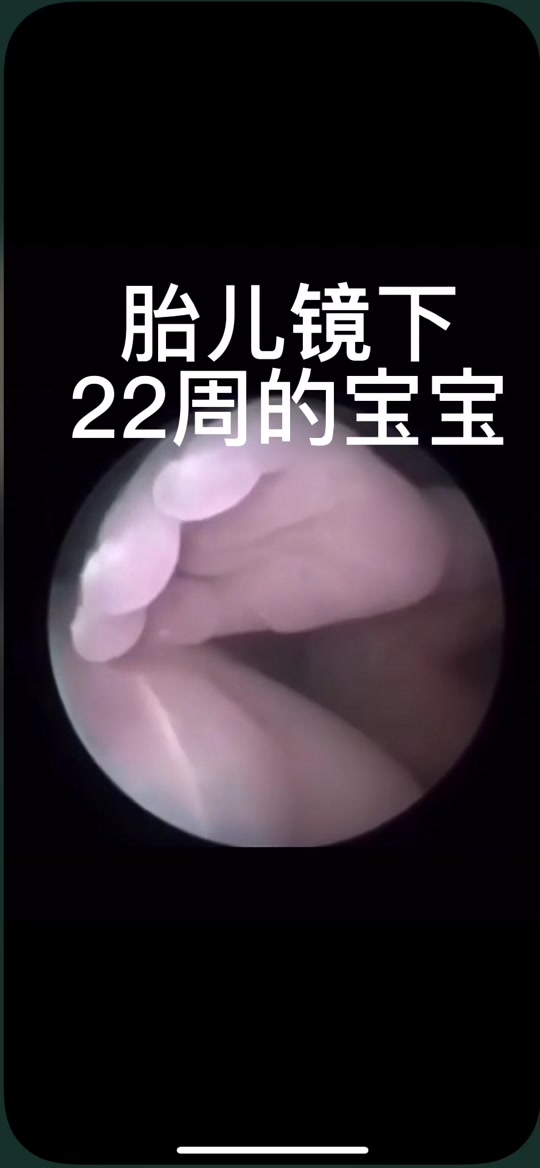 27周胎儿镜下的宝宝