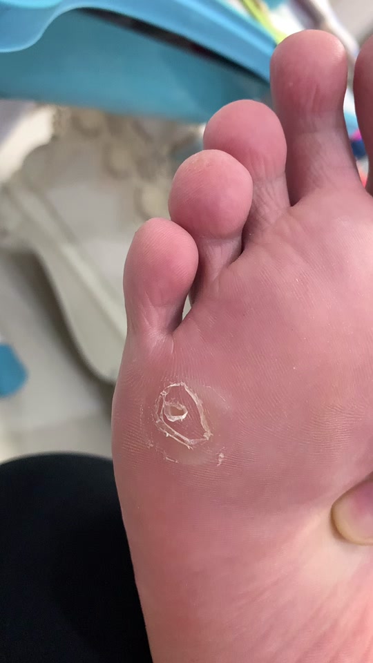 鸡眼膏贴完后变白的肉要弄掉吗 - 抖音