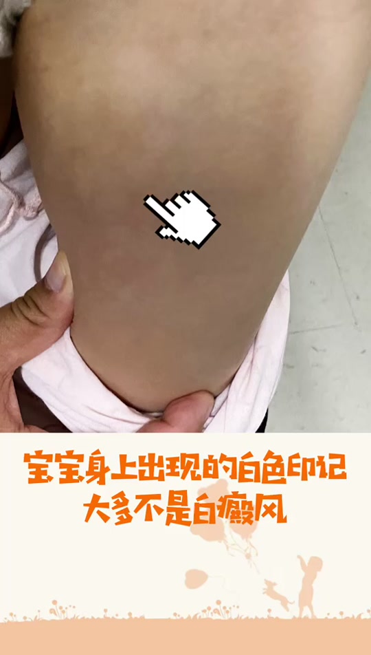 白色胎记稀有吗