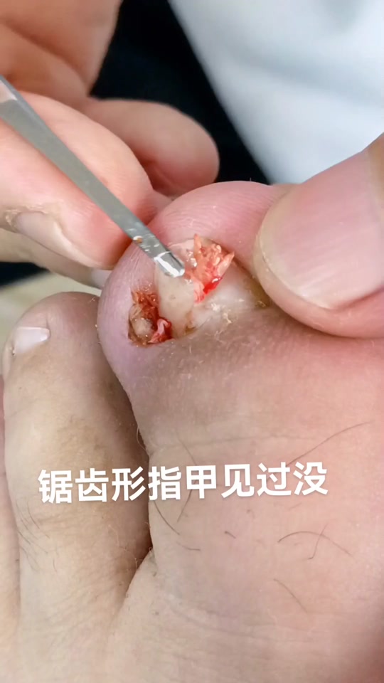 锯齿形指甲_锯齿形指甲图_锯齿形指甲搞笑说说 - 抖音