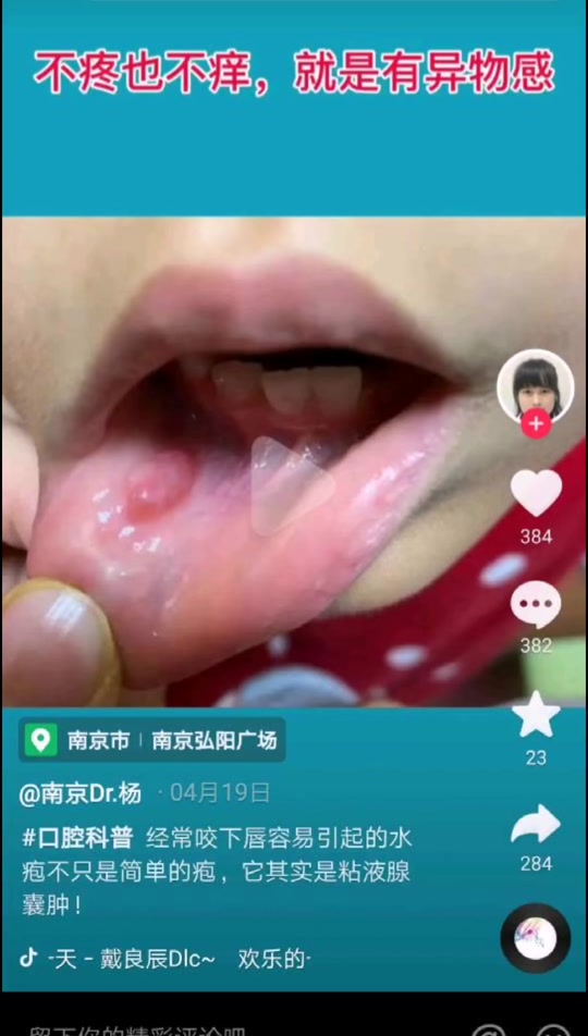 口腔内腮部长了个肉疙瘩 - 抖音