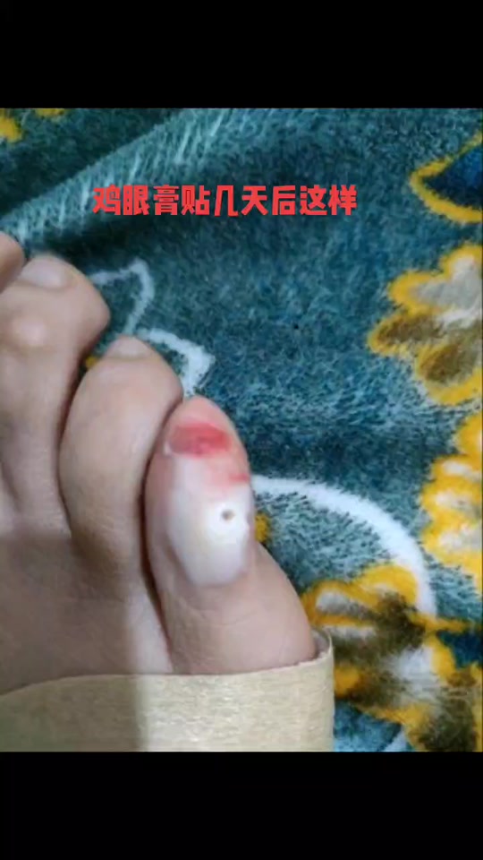 鸡眼膏贴完后变白的肉要弄掉吗 - 抖音