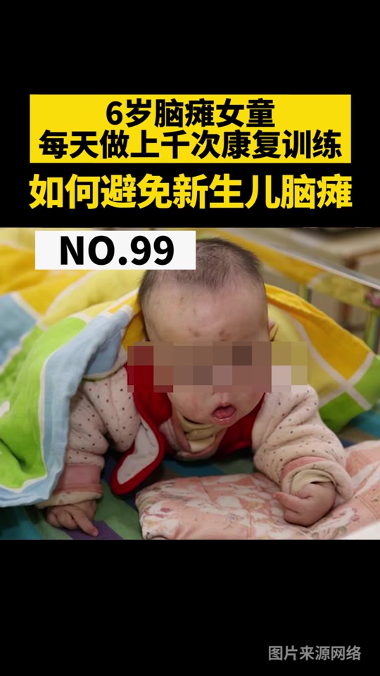 婴儿脑瘫的最明显的征兆有三种