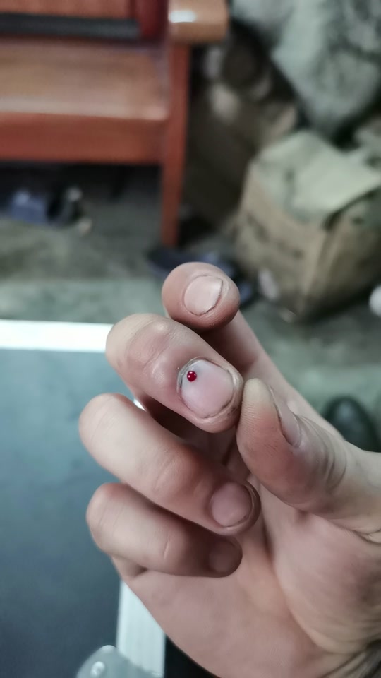 给指甲放淤血操作