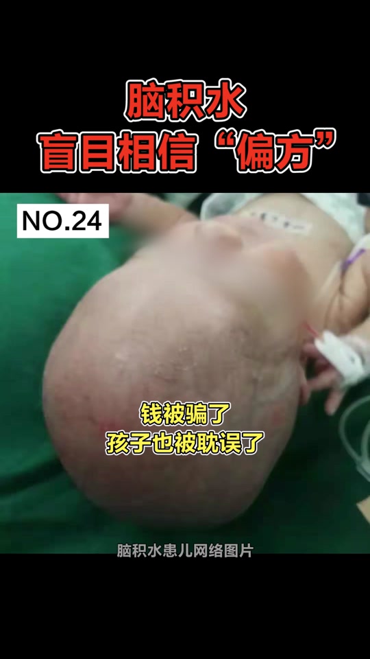 脑积水大头娃娃_脑积水大头娃娃现在怎么样了_脑积水大头娃娃能活多久