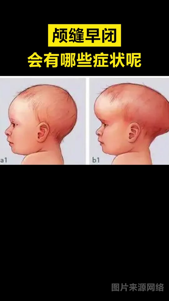 狭颅症宝宝有什么征兆_怎样区别舟状头和狭颅症