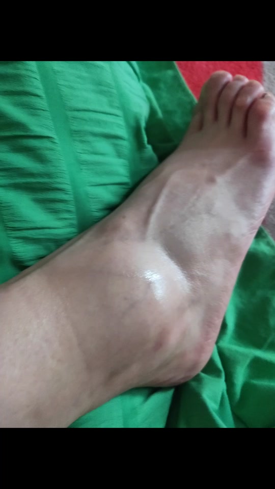 脚受伤了如何幽默的发朋友圈