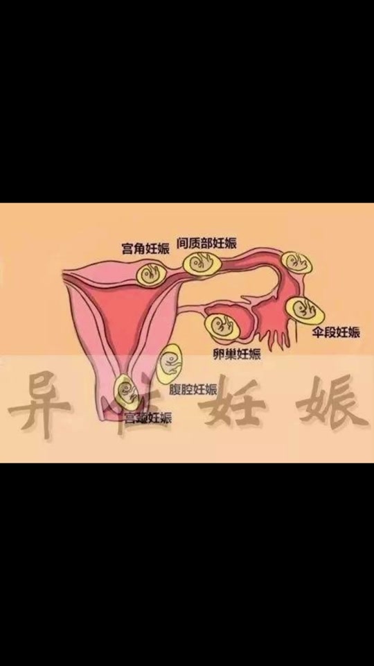 异位妊娠最常见的部位是