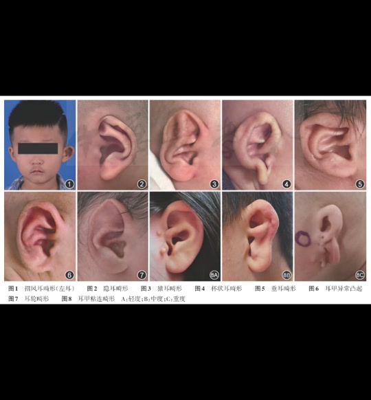 新生儿耳朵_新生儿耳朵卷边有必要矫正吗_新生儿耳朵轮廓畸形矫正最佳