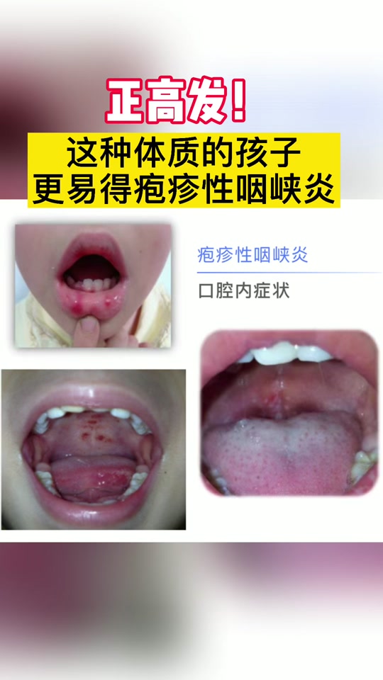 疱疹性咽峡炎拉肚子怎么办 - 抖音