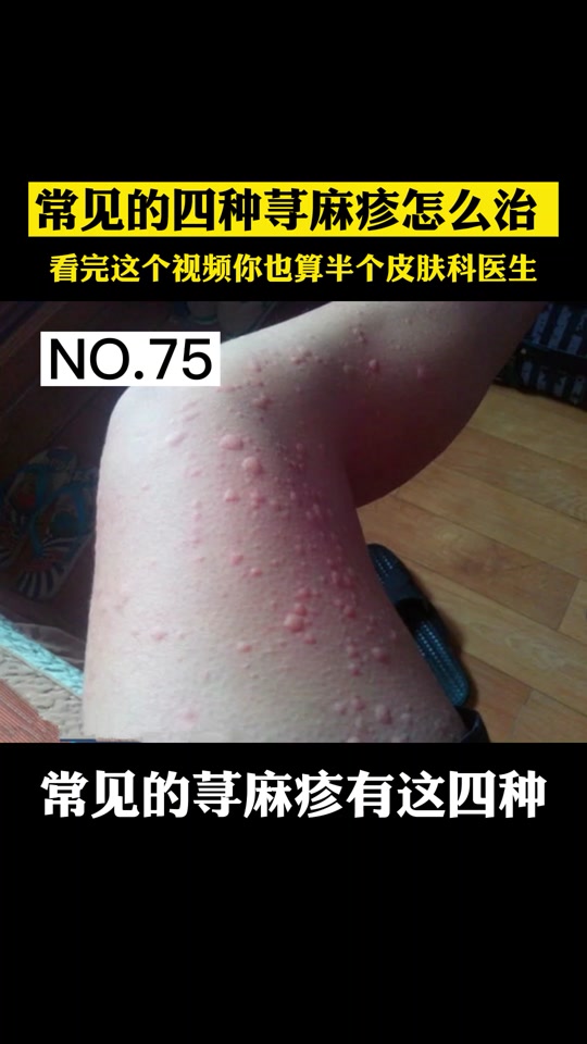 吹空调身上起疙瘩很痒 - 抖音