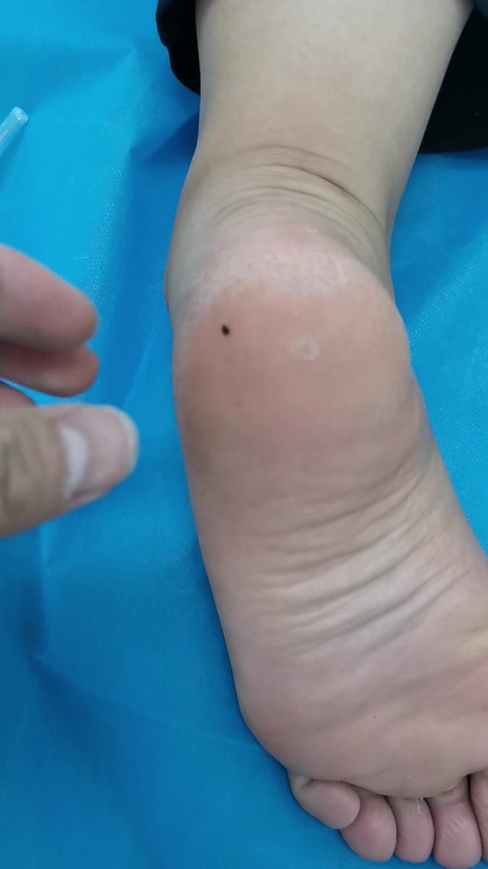 足跟脂肪垫炎症成因