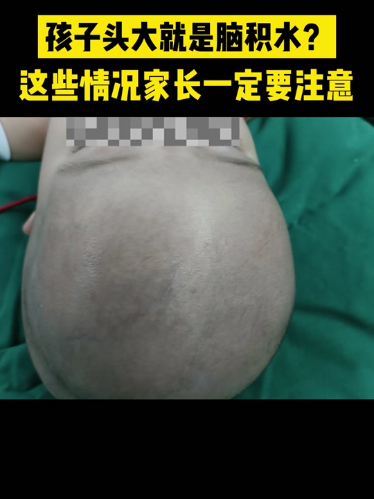 脑积水大头娃娃_脑积水大头娃娃现在怎么样了_脑积水大头娃娃能活多久