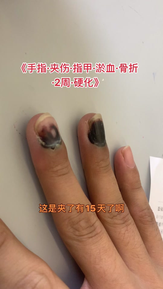 给指甲放淤血操作