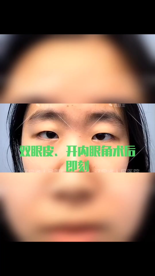 开内眼角前后对比男士