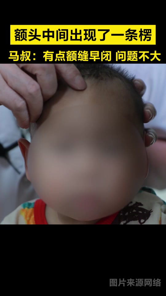 新生儿头顶上有一条鼓起的棱