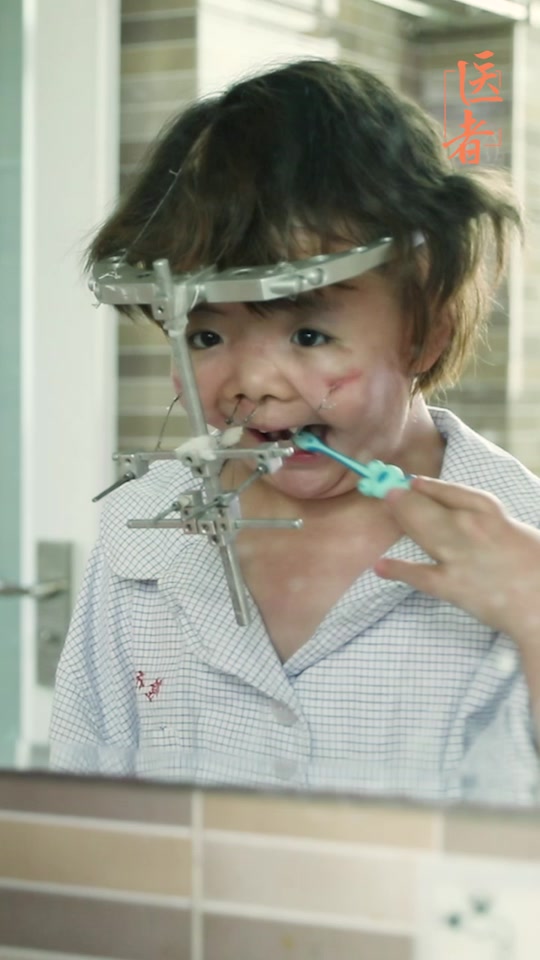 猫叫综合征患者面容