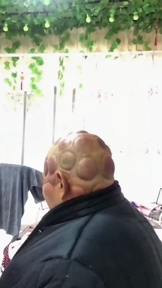 山西人脑门拔罐