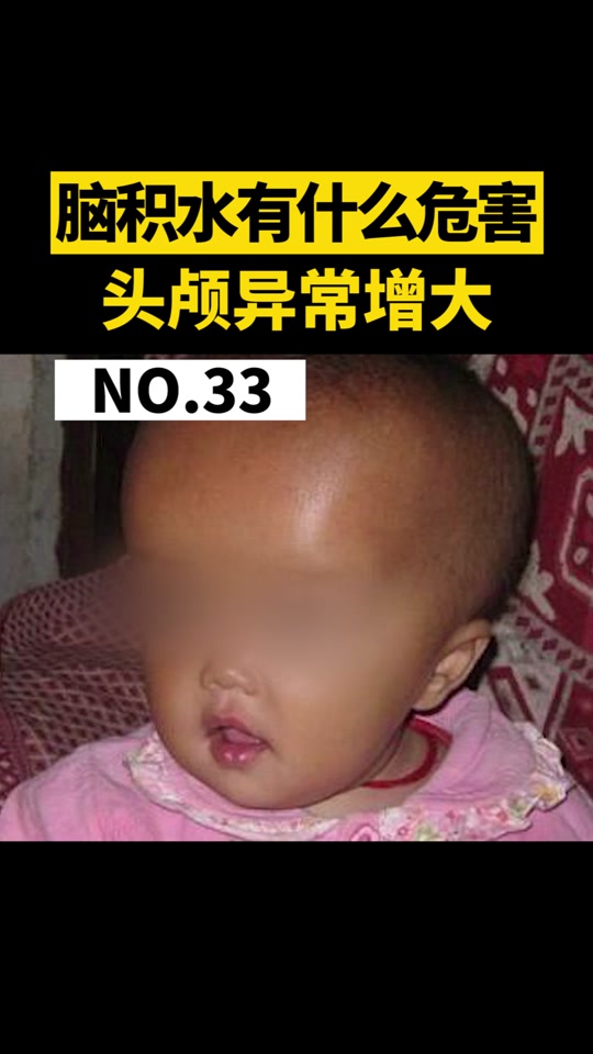 脑积水大头娃娃_脑积水大头娃娃现在怎么样了_脑积水大头娃娃能活多久