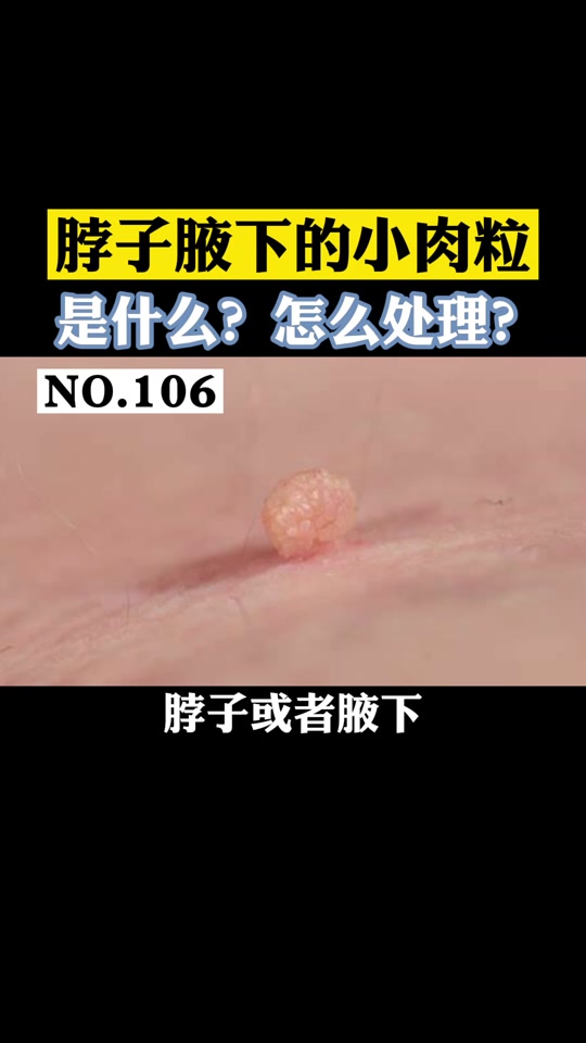 为什么身体会长小肉粒呢为什么在线