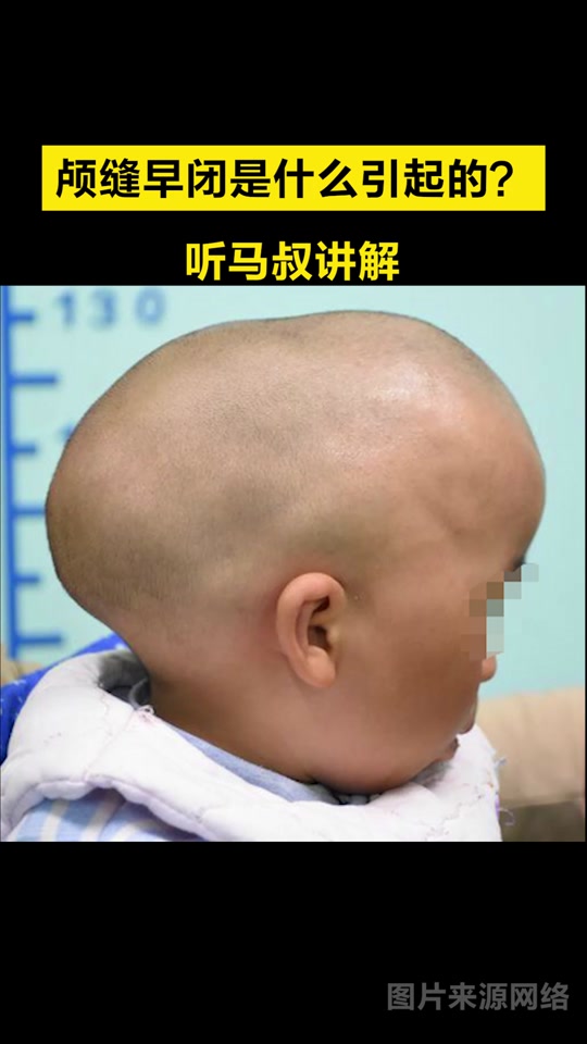 狭颅症的症状有哪些