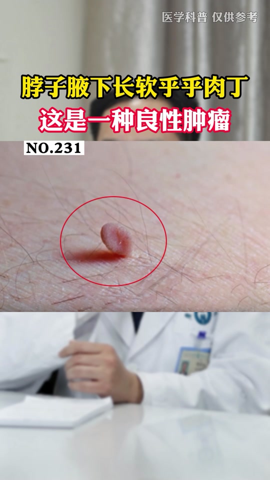 胳肢窝长了个小肉粒 使劲拽掉了_胳肢窝长了个小