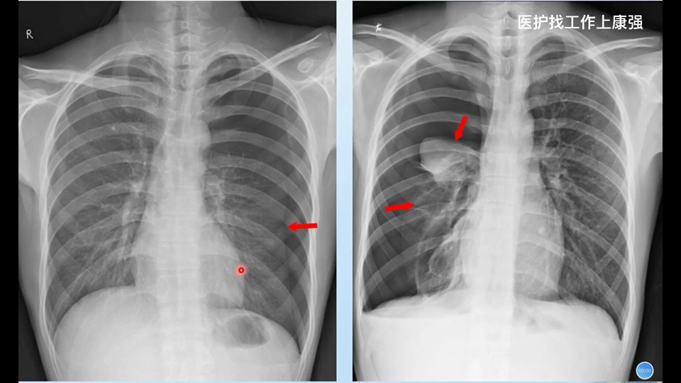 北京胸科医院CT加急-北京胸外科最好的医院排名榜前十名 