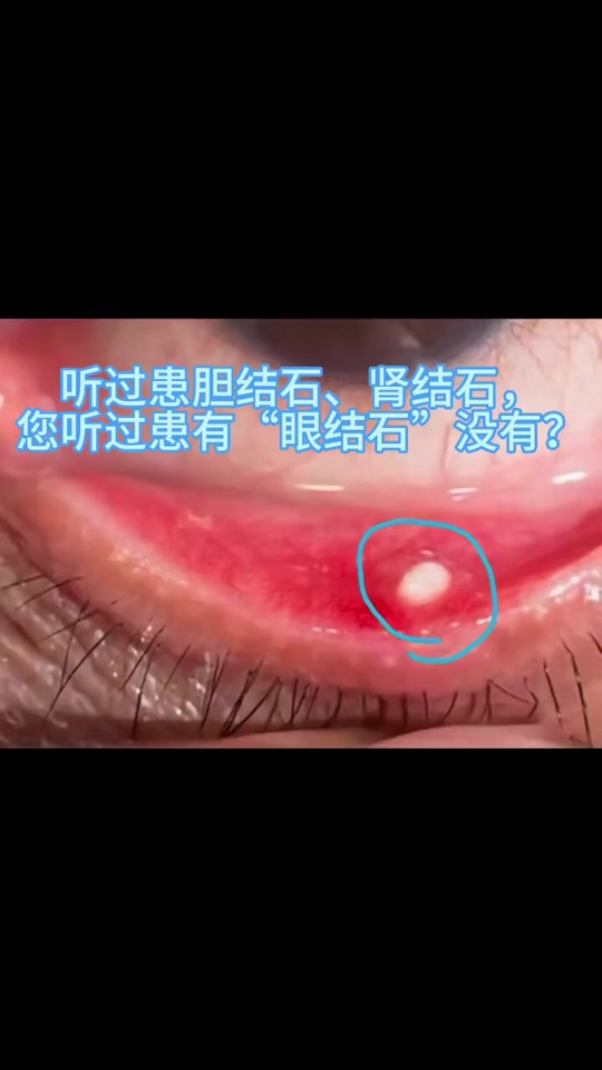 30岁女子眼睛竟长出5颗结石