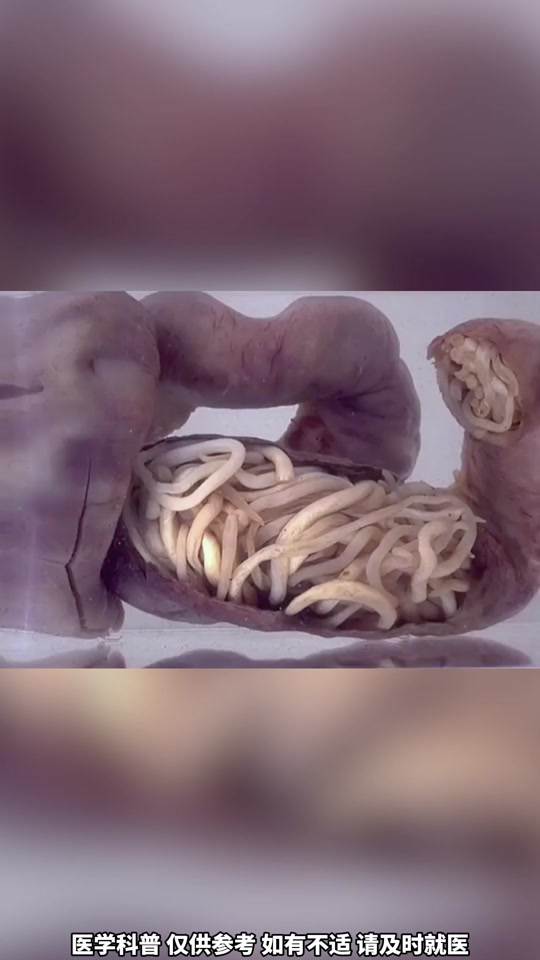 男孩肚子长满寄生虫