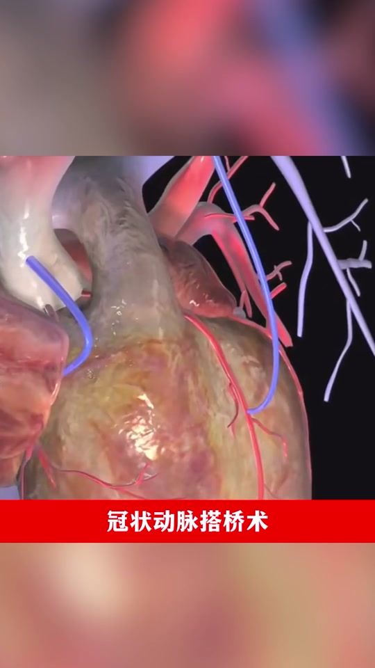 冠心病治疗方式:心脏搭桥手术,医学动画科普 #3d动画演示 #冠心病