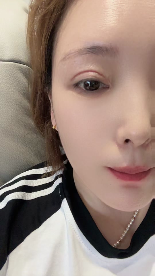 开眼角的疤痕增生图