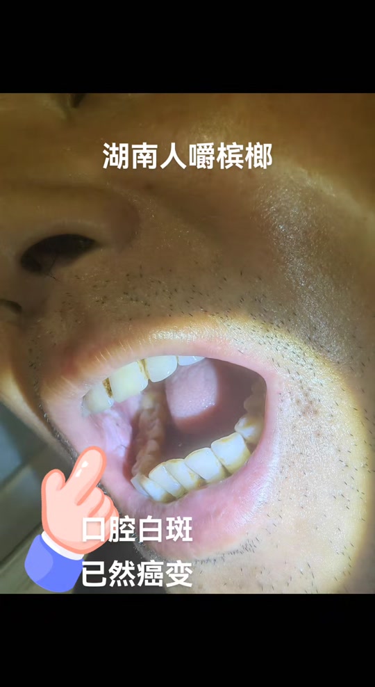 槟榔致口腔病变案例