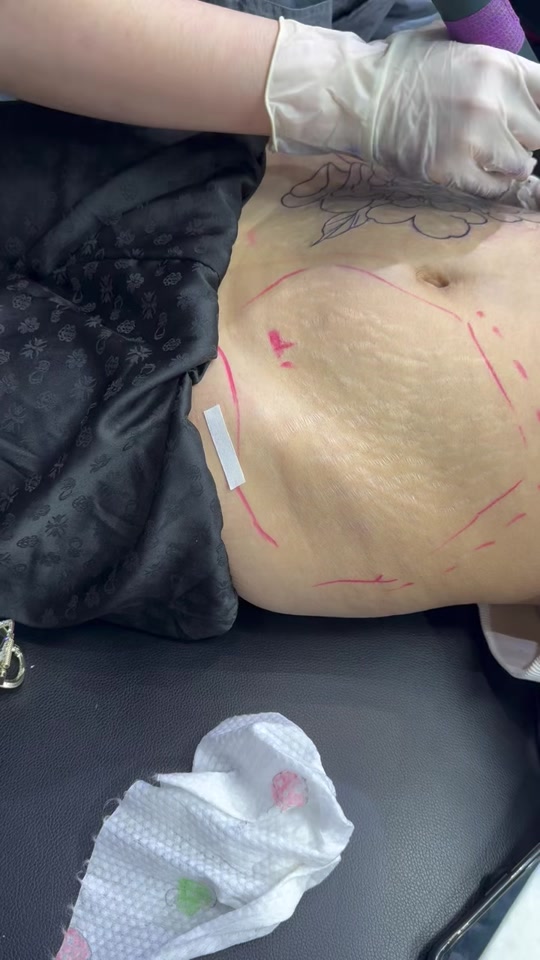 女子为遮一胎妊娠纹在腹部纹身