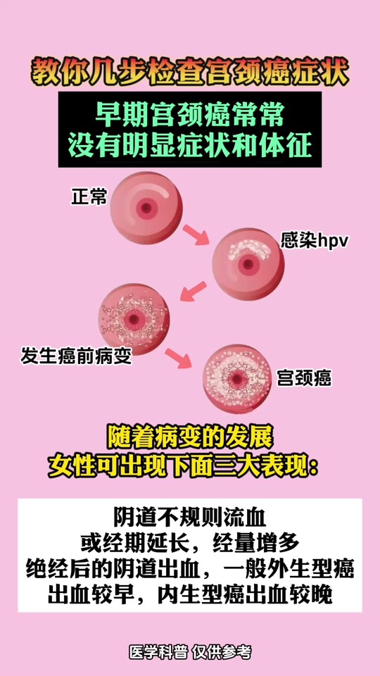 宫颈癌早期症状