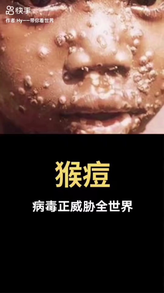 包含2019年发生的疫情叫什么病毒的词条