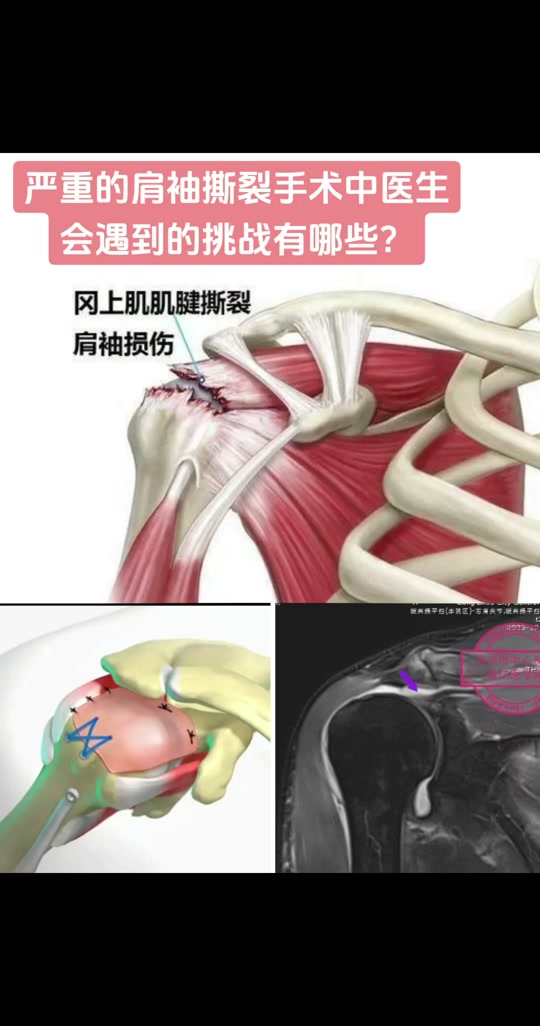 科比肩袖撕裂