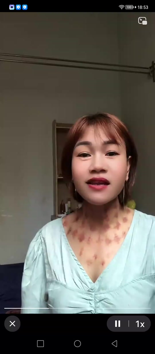 美女新年揪痧_美女揪痧完整