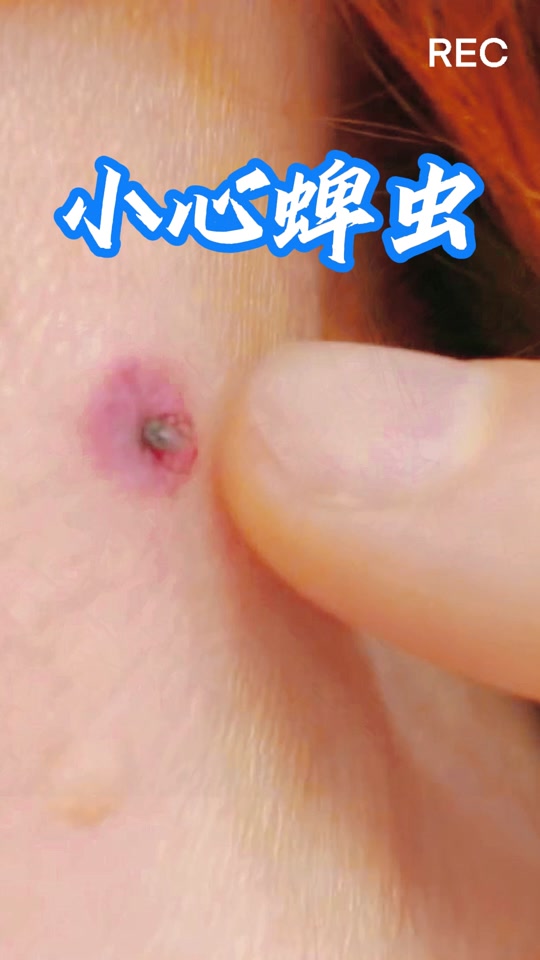 蜱虫已经完全钻入身体内的样子