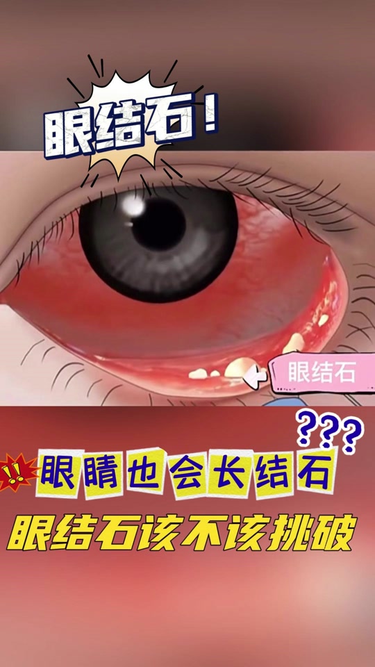 眼睛里长了很多小结石