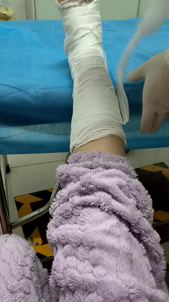 小姐姐腿骨折打石膏坐轮椅断了